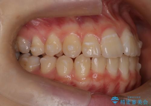 マウスピース矯正で前歯のガタツキを改善! 短期間で治療完了の治療中