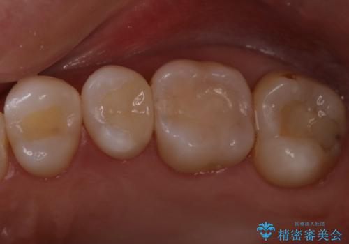 矯正後セラミックインレーにしたい