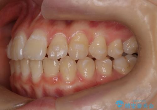 マウスピース矯正で前歯のガタツキを改善! 短期間で治療完了の治療中