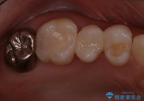 銀歯をセラミックに変えたい　セラミックインレーの治療後