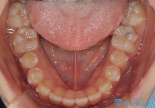 マウスピース矯正で前歯のガタツキを改善! 短期間で治療完了の治療中