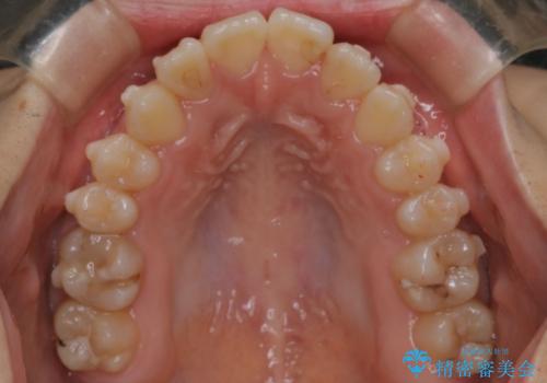 マウスピース矯正で前歯のガタツキを改善! 短期間で治療完了の治療中