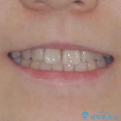 虫歯治療ついでに歯並びの後戻りを改善　インビザラインによる矯正治療の治療後（顔貌）