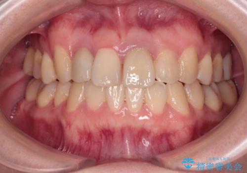 虫歯治療ついでに歯並びの後戻りを改善　インビザラインによる矯正治療の症例 治療後
