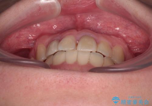 虫歯治療ついでに歯並びの後戻りを改善 インビザラインによる矯正治療の治療後