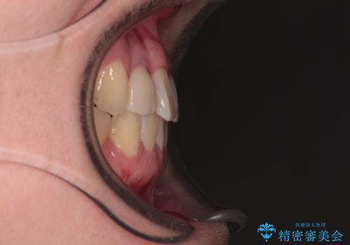 虫歯治療ついでに歯並びの後戻りを改善 インビザラインによる矯正治療の治療後