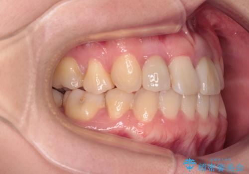 虫歯治療ついでに歯並びの後戻りを改善 インビザラインによる矯正治療の治療後