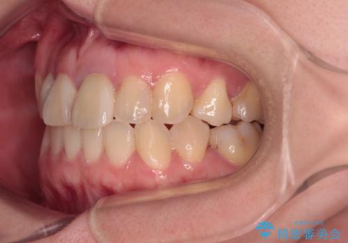 虫歯治療ついでに歯並びの後戻りを改善 インビザラインによる矯正治療の治療後