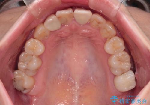 虫歯治療ついでに歯並びの後戻りを改善 インビザラインによる矯正治療の治療後