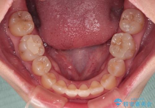 虫歯治療ついでに歯並びの後戻りを改善 インビザラインによる矯正治療の治療後