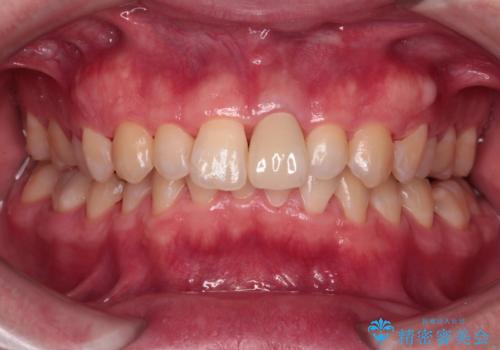 変色した前歯をオールセラミッククラウンにの治療後