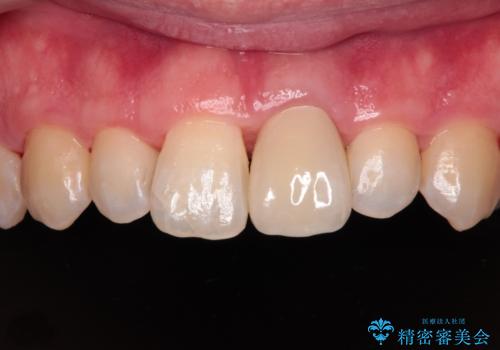 変色した前歯をオールセラミッククラウンにの治療後