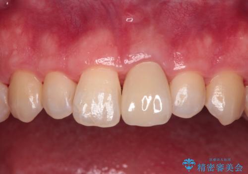 変色した前歯をオールセラミッククラウンにの治療後