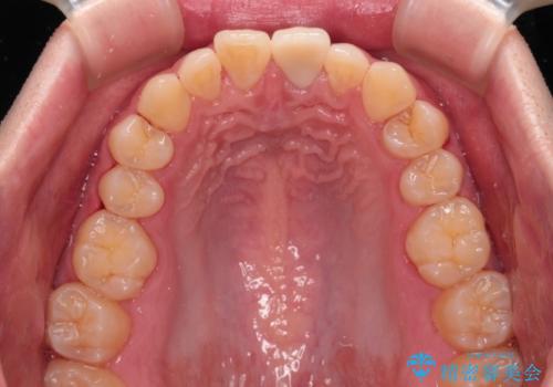 変色した前歯をオールセラミッククラウンにの治療後