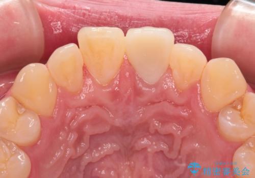 変色した前歯をオールセラミッククラウンにの治療後