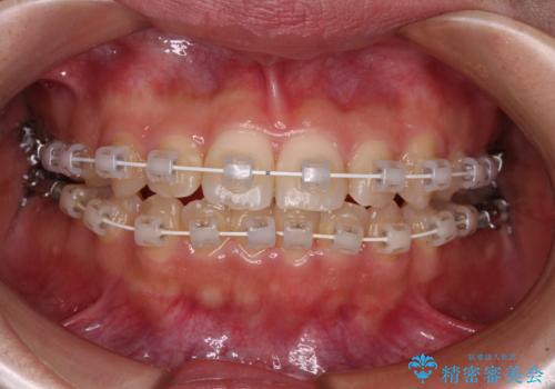 【モニター】短期間で終わりたい ワイヤー装置での非抜歯矯正の治療中