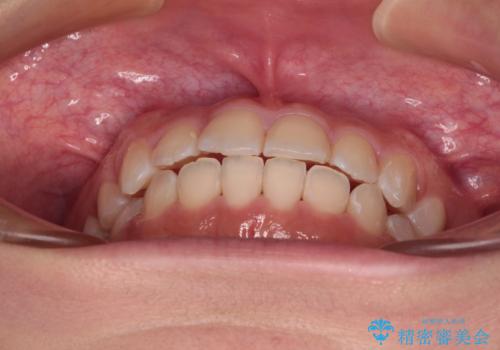 【モニター】短期間で終わりたい ワイヤー装置での非抜歯矯正の治療後