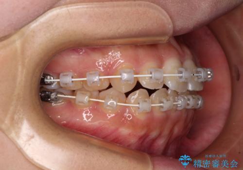 【モニター】短期間で終わりたい　ワイヤー装置での非抜歯矯正の治療中