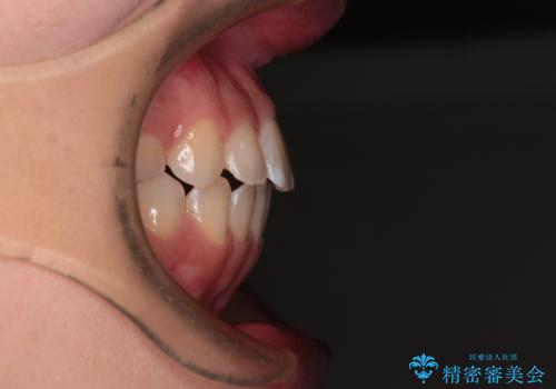 【モニター】短期間で終わりたい ワイヤー装置での非抜歯矯正の治療後