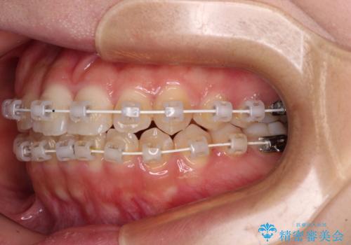 【モニター】短期間で終わりたい ワイヤー装置での非抜歯矯正の治療中
