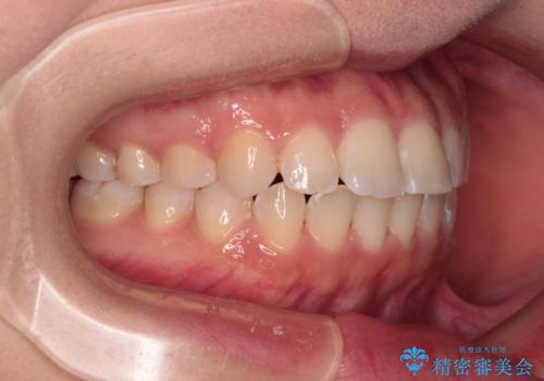 【モニター】短期間で終わりたい ワイヤー装置での非抜歯矯正の治療後