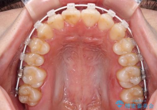 【モニター】短期間で終わりたい ワイヤー装置での非抜歯矯正の治療中