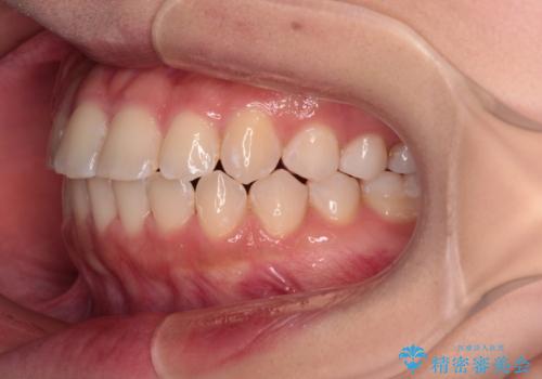 【モニター】短期間で終わりたい ワイヤー装置での非抜歯矯正の治療後