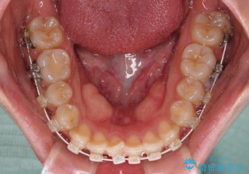 【モニター】短期間で終わりたい ワイヤー装置での非抜歯矯正の治療中