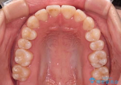 【モニター】短期間で終わりたい ワイヤー装置での非抜歯矯正の治療後
