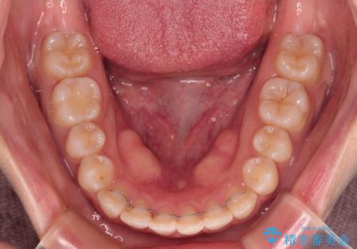 【モニター】短期間で終わりたい ワイヤー装置での非抜歯矯正の治療後