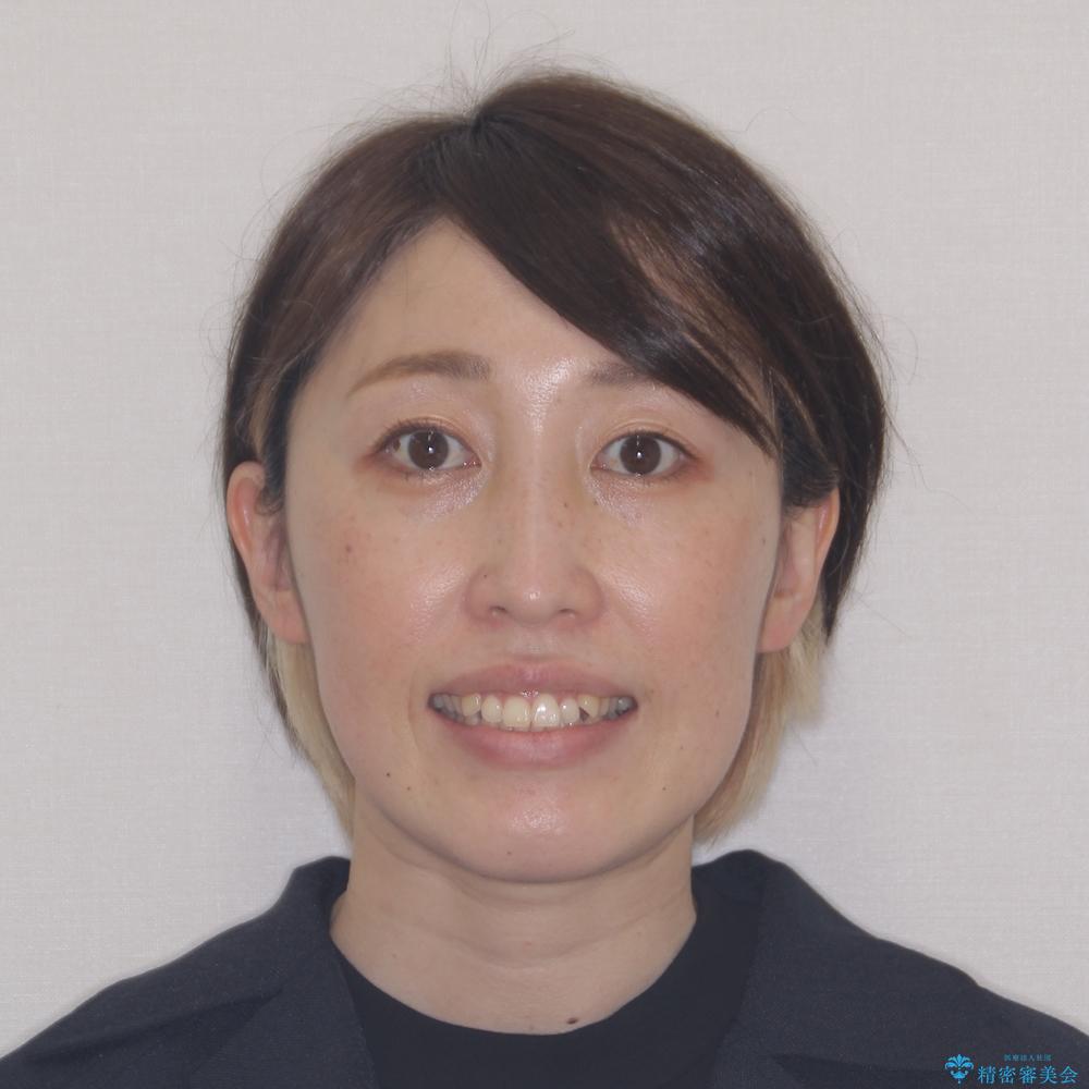 【モニター】カリエール・ディスタライザーを併用した八重歯のインビザライン矯正 の治療前(顔貌)