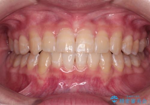 【モニター】下顎前歯のデコボコをインビザラインできれいに