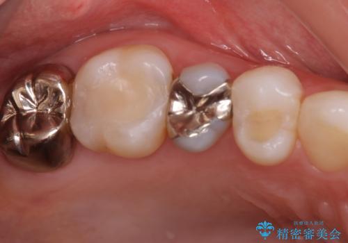 銀歯をセラミックに変えたい　セラミックインレーの症例 治療前