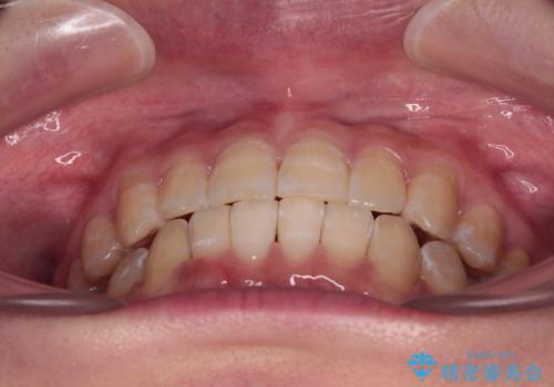 【モニター】下顎前歯のデコボコをインビザラインできれいにの治療後