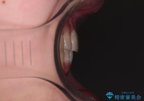 【モニター】下顎前歯のデコボコをインビザラインできれいにの治療後