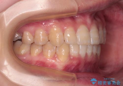 【モニター】下顎前歯のデコボコをインビザラインできれいにの治療後