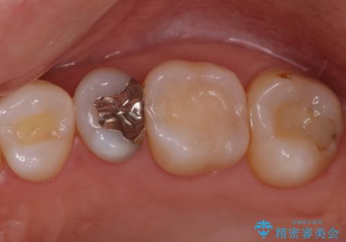 矯正後セラミックインレーにしたいの症例 治療前