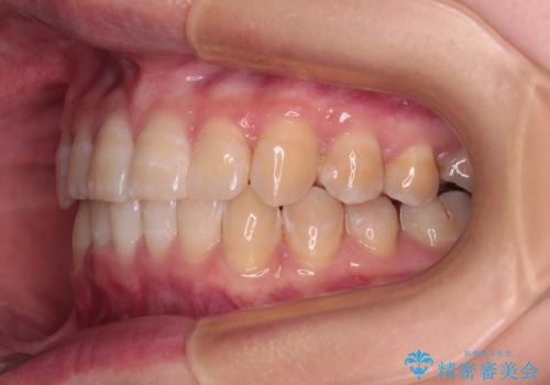 【モニター】下顎前歯のデコボコをインビザラインできれいにの治療後