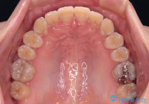 【モニター】下顎前歯のデコボコをインビザラインできれいにの治療後