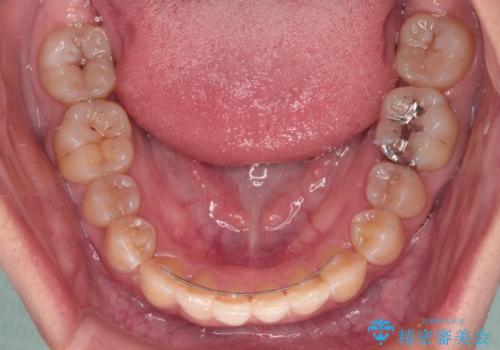 【モニター】下顎前歯のデコボコをインビザラインできれいにの治療後