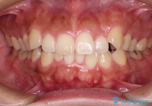 【モニター】カリエール・ディスタライザーを併用した八重歯のインビザライン矯正　の症例 治療前