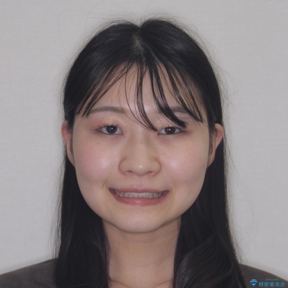 【モニター】下顎前歯のデコボコをインビザラインできれいにの治療後(顔貌)