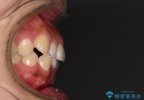 【モニター】カリエール・ディスタライザーを併用した八重歯のインビザライン矯正　の治療前