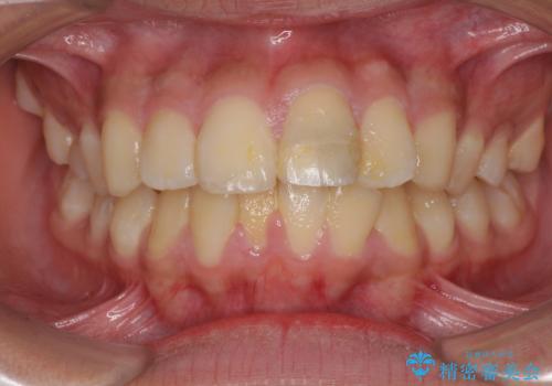 膨らんだ口元 ワイヤー装置での抜歯矯正の治療前