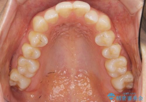 前歯のガタつきをマウスピースで治したい!の治療前