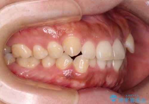 【モニター】カリエール・ディスタライザーを併用した八重歯のインビザライン矯正 の治療前