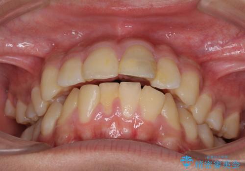 膨らんだ口元 ワイヤー装置での抜歯矯正の治療前