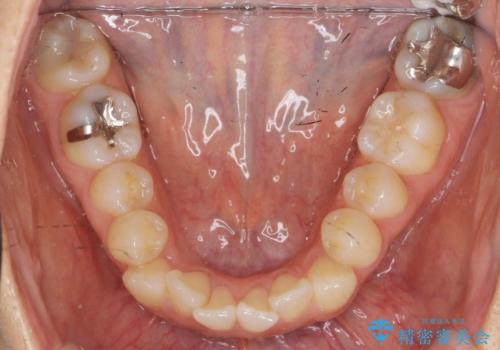 前歯のガタつきをマウスピースで治したい!の治療前
