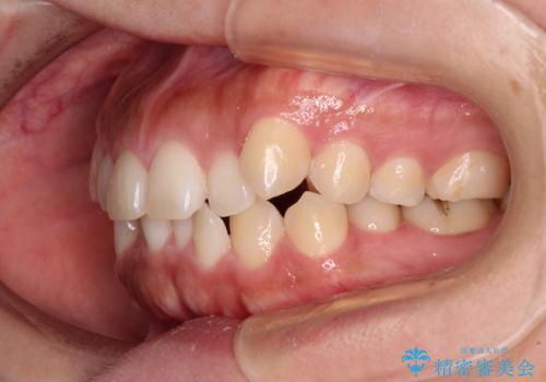 【モニター】カリエール・ディスタライザーを併用した八重歯のインビザライン矯正 の治療前