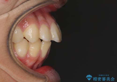 膨らんだ口元 ワイヤー装置での抜歯矯正の治療前